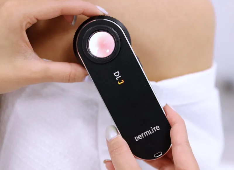 Hand holding a handheld dermatoscope used for skin checks